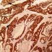 Immunohistochemical expression of CK20, ...
