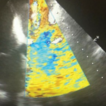 Trans-catheter ...