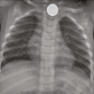 Foreign bodies in the esophagus in children ...