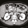 Endovascular repair of symptomatic fistulized ...