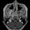 A nine-year-old child with nasopharyngeal ...
