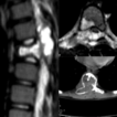 Spinal aneurysmal bone cysts – case s ...