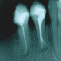 Deviant morphology of the root canal system in mandibular